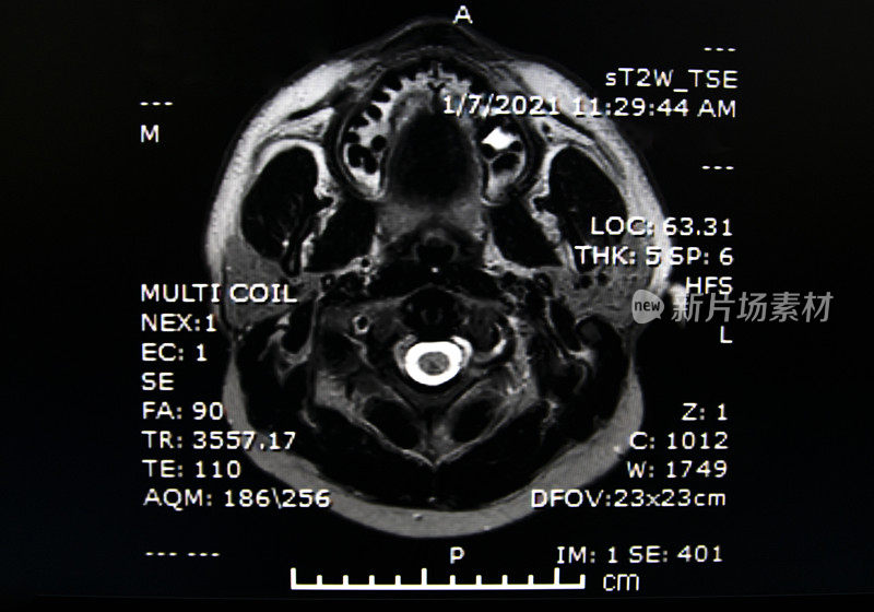 大脑的磁共振成像(MRI brain)。